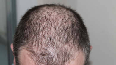 Factors to Know About Minoxidil
